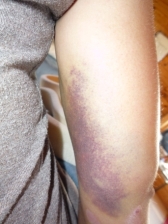 Bruised & broken Bruised & broken